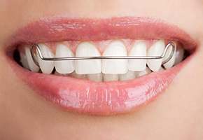 Ортодонтические пластинки самый легкий способ исправить прикуc
